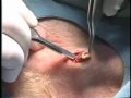 ex�r�se d'un kyste �pidermique de la r�gion cervicale