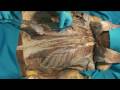 Disecci�n de la Espalda
