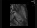 4D echo 5mo old