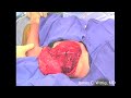 Osteosarcoma Proximal Humerus Part 6 of 6 Osteosarcoma Proximal Humerus Part 6 of 6