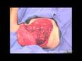 Osteosarcoma Resection Of The Humerus Proximal End - Part 6/6 Osteosarcoma Resection Of The Humerus Proximal End - Part 6/6