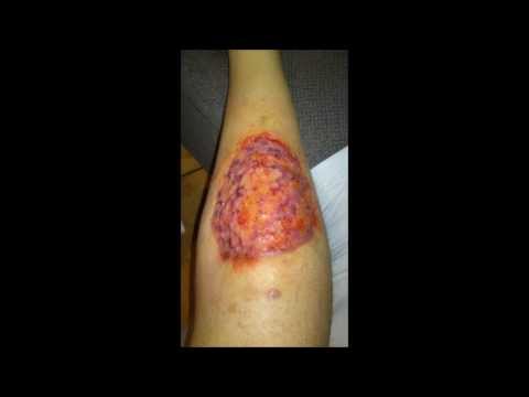 how to treat group g strep