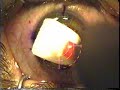 My Laser Eye Surgery in 47 Seconds