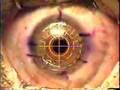 My Laser Eye Surgery in 47 Seconds