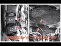 腰椎椎間板ヘルニアの原因と対策 椎間板ヘルニア