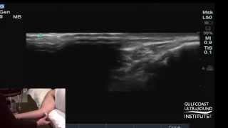 The Intricacies of Ulnar Nerve Dislocation and Snapping through Ultrasound Demonstrations