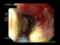 Stent In Esophagus - Placement