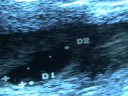 PREGNANCY 6.1 WEEKS- EMBRYO AND GESTATIONAL SAC