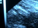 PREGNANCY 6.1 WEEKS- EMBRYO AND GESTATIONAL SAC