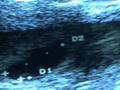 videos de PREGNANCY 6.1 WEEKS- EMBRYO AND GESTATIONAL SAC