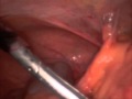Ovarian Torsion with Dense Adhesions