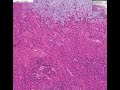 Histopathology Salivary gland--Pleomorphic adenoma (mixed tu Histopathology Salivary gland--Pleomorphic adenoma (mixed tu