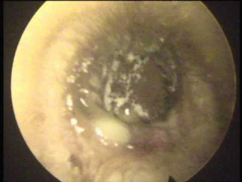 how to remove ear fungus