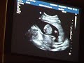 Gender Ultrasound Week 17 1/2