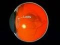Rezoom Multifocal Lens