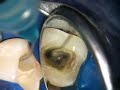 Molar endodontic therapy Molar endodontic therapy