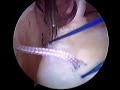 Torn Labrum #3
