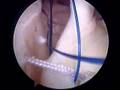 Torn Labrum #3