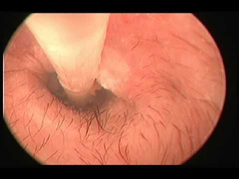how to drain otitis media