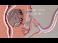Fibroid Treatment Options - Mayo Clinic