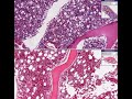 Histopathology Bone marrow -- adenocarcinoma, metastatic Histopathology Bone marrow -- adenocarcinoma, metastatic
