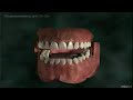 Лечение каналов зуба - Root canal treatment of tooth