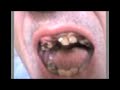 dentadura perfecta