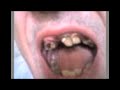 dentadura perfecta