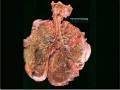 Medical School Pathology, Chapter 10h