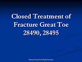 Closed Treatment of Fracture Great Toe - Codes 28490