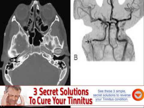 causes of tinnitus tmj