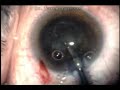 Kinked Tecnis Haptic