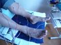 Acupuncture as treatment of chemotherapy induced neuropathy