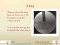 XLIF, Extreme Lateral Interbody Fusion by Pablo Pazmino, MD