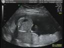 Baby Midkiff 2 of 5
