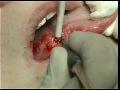 Excisional biopsy of the lateral border of the tongue
