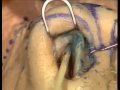 Rhinoplasty Course Dissection
