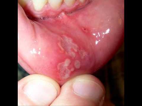 how to control ulcer