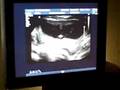 Blueberry's Ultrasound Video 2 (July 23, 2008)