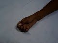 pseudoseizure is a movement that mimicks seizure, may stop voluntarily as in this case, its very easy to mistake this as a seizure, unless u see the willful stop. - dr kondekar SV www.peditips.com