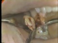 Horizontal Mandibular Impaction and Maxillary Third Molar