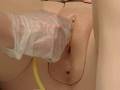 Foley catheter insertion