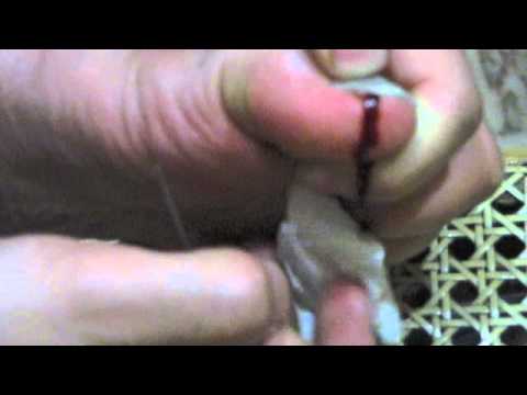 how to drain subungual hematoma