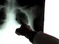 Tele de Torax (Derrame pleural)