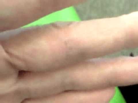 ④指怪我出血治癒14時36分撮影.骨折 推拿 気功 整体