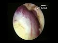 New GreenLight Laser PVP Treatment for BPH