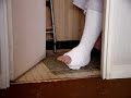 Moving toes on a plaster wamlking cast Moving toes on a plaster wamlking cast