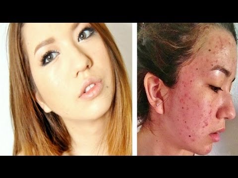 Acne Coverage Foundation Routine