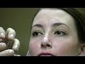 Botox Injection Technique for Wrinkle Reduction in Virginia