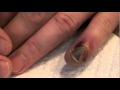 Broken Finger! Me squeezing infected pus out of my broken finger tip.